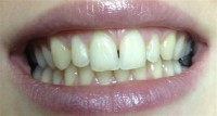 Izbjeljivanje zuba-prije 1